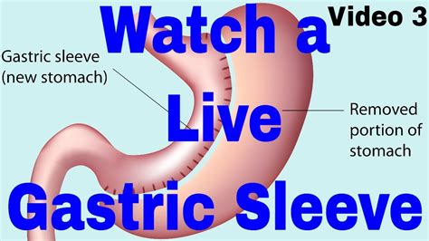 Live Gastric Sleeve Surgery.LAPAROSCOPIC SLEEVE GASTRECTOMY. - YouTube