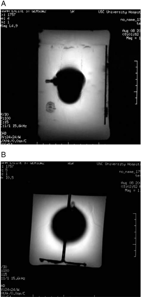 Figure 1 from Magnetically programmable shunt valve: MRI at 3-Tesla ...