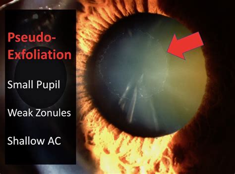 Pseudo-Exfoliation Cataract Surgery – Cataract Coach