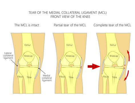 Acl and mcl surgery