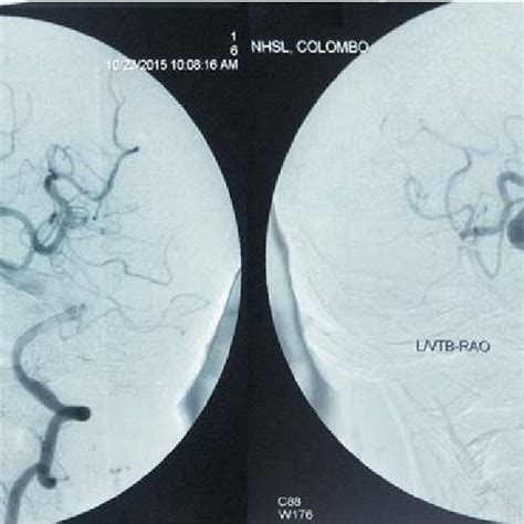 Contrast CT showing vertebrobasilar dolichoectasia | Download Scientific Diagram