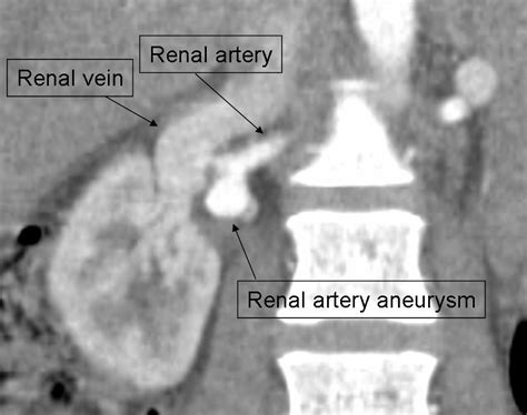 Renal artery aneurysm diagnosis and treatment