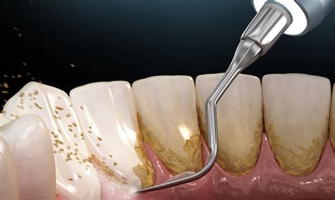 Ultrasonic Scaling in Shillong, Meghalaya