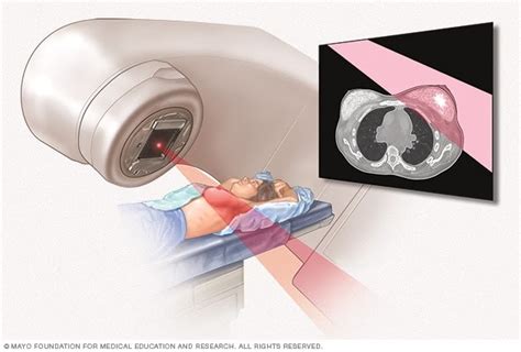 Skin After Radiation Therapy For Breast Cancer - All About Radiation