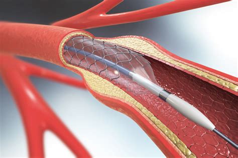 Polymeric Materials And Coronary Angioplasty Devices