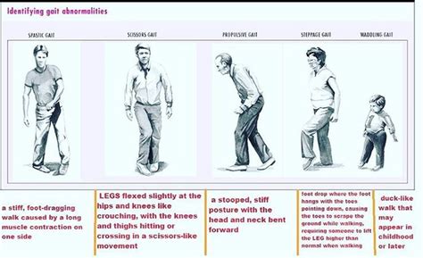 Gait Abnormalities | Medical school stuff, Physical therapy assistant ...