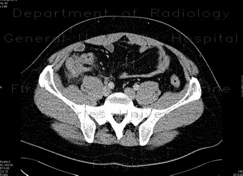 Radiology case: Inflammation of the cecum