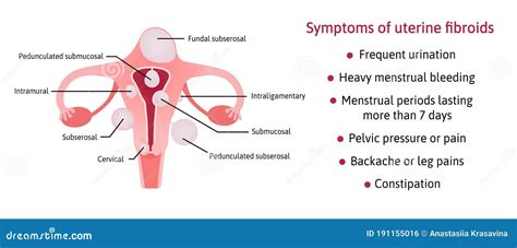 Uterine Fibroids and Its Symptoms. List of Symptoms. Different ...