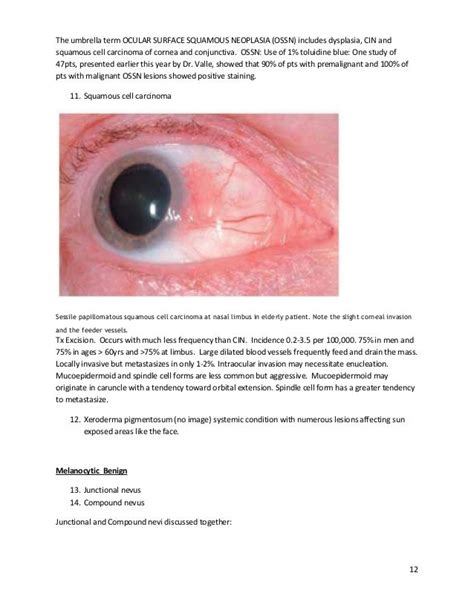 Conjunctival tumors