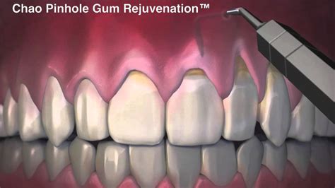 Pinhole Gum Rejuvenation - Beautiful Smiles of Long Island