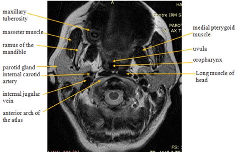 Figure 2 from Anatomy and common pathology of the parotid space: The imaging appearance ...