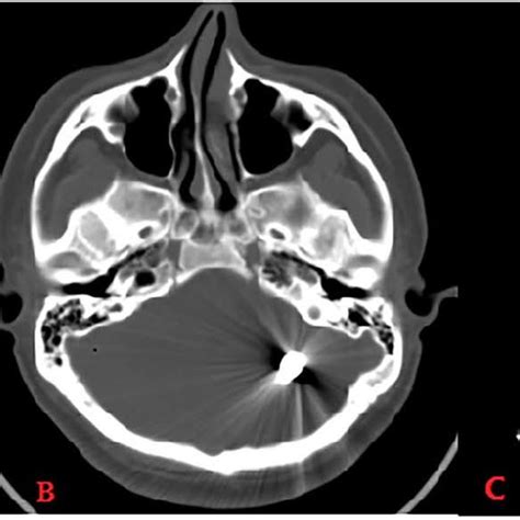 Computed tomography (bone window: A: coronal, B: axial) reveals ...