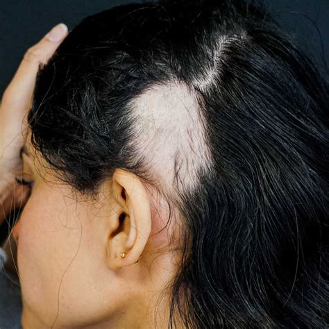 Alopecia Areata | DR. VÍCTOR PINOS | Dermatólogo Experto en Alopecias