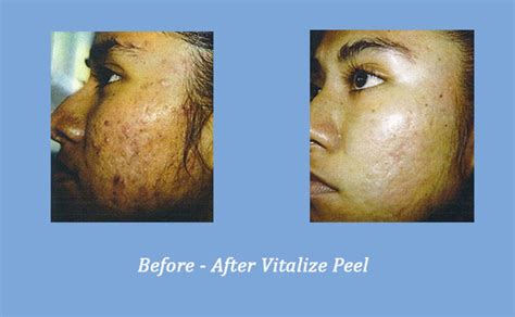 Vitalize Peel Before & After - Georgia Dermatology Center