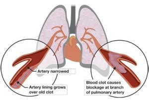 Pulmonary endarterectomy | PHA