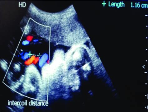 Measurement of intercoil distance (umbilical cord index 0.86) in a... | Download Scientific Diagram