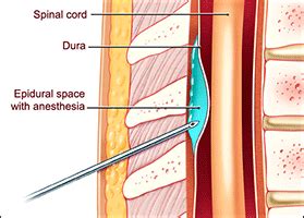 Epidural or Spinal - Dr Emeil Kamel