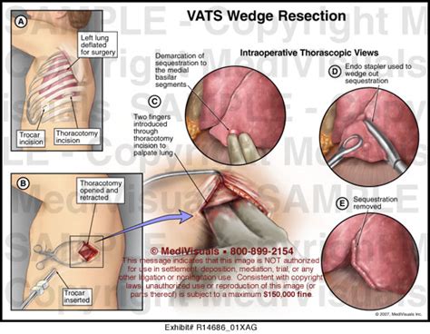 VATS Wedge Resection MediVisuals Medical Illustration