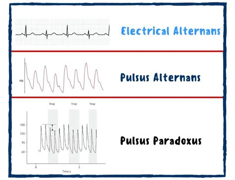 Pulsus Alternans |Causes |Signs & Symptoms - Nurseship.com