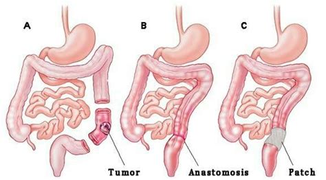 Anastomosis | Open access journals, Colorectal, Nursing tips