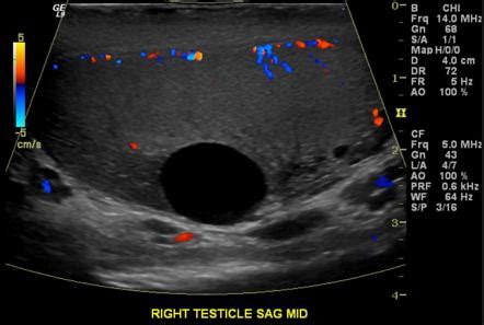 Testicular cyst | Radiology Reference Article | Radiopaedia.org