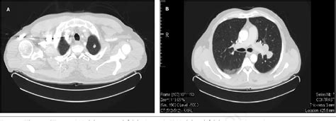 Retrocrural lymph node | Semantic Scholar