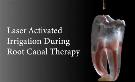 How to Resolve a Root Canal Infection - A Pardigm Shift - Integrative Dentistry, San Diego ...