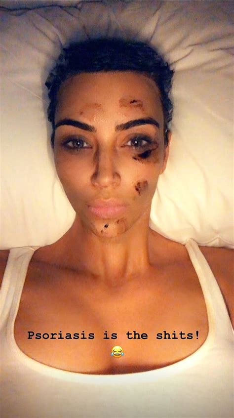 Kim Kardashian Shares Selfie Using an Herbal Ointment to Fight the ...