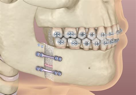 An Overview of Mandibular Osteotomy | Jaw Surgery