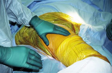 Hip replacement surgery - Stock Image - M551/0341 - Science Photo Library