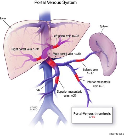 Portal Vein Thrombosis