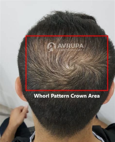 Your Ultimate Guide to Crown Hair Transplant | ClinicAdvisor®