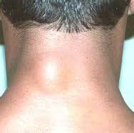 Swollen lymph nodes