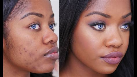 Simple Natural Remedies To Get Rid Of Face Blemishes – Natural Junkie