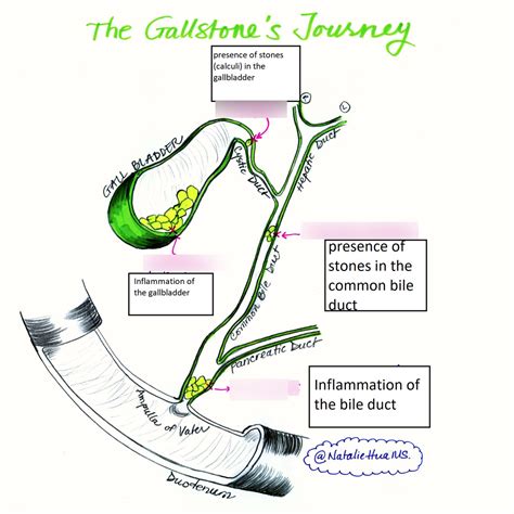 Labeling: The Gallstone's Journey Diagram | Quizlet