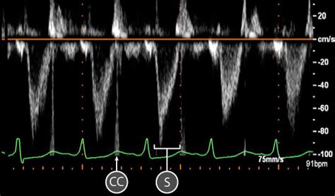 Virtual TEE: Using spectral Doppler to evaluate the left ventricular outflow tract