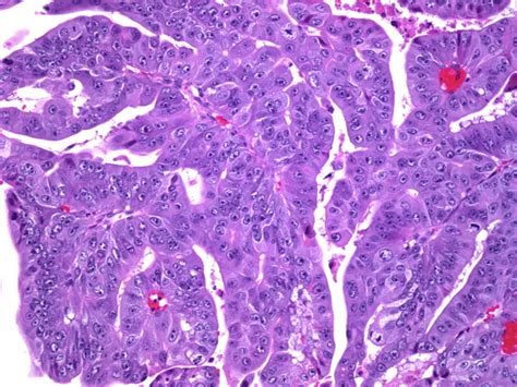 Webpathology.com: A Collection of Surgical Pathology Images