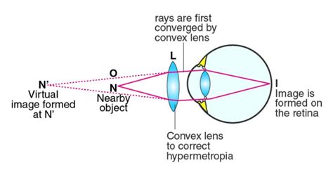 a) What is long-sightedness? State the two causes of long-sightedness. With the help of ray ...