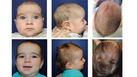 Craniosynostosis Surgery | Children's Hospital of Philadelphia