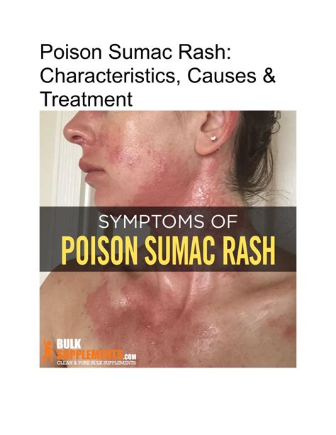 Poison Sumac Rash