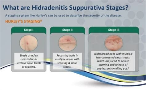 Hidradenitis Suppurativa Hs Hurley Stages – Otosection