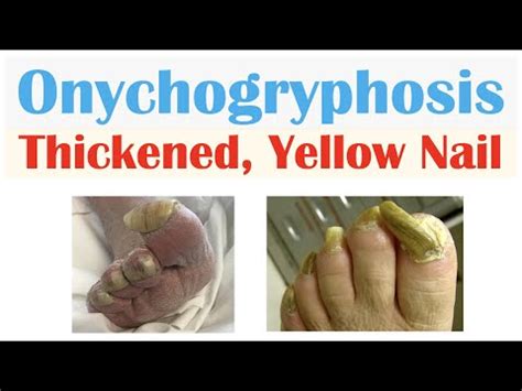 Onychogryphosis (Thickened, Yellow Nails) | Causes, Signs & Symptoms ...