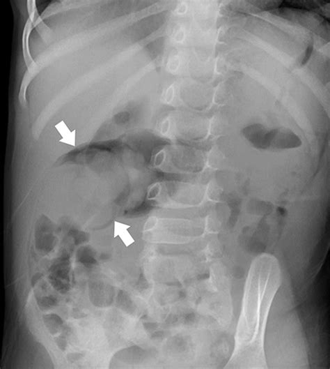 How to Diagnose Intussusception in Children • APPLIED RADIOLOGY