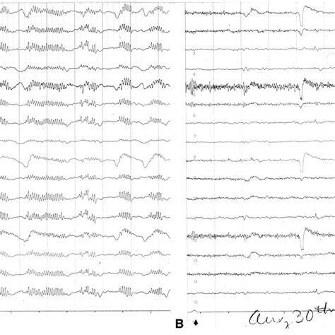 (PDF) The EEG in metabolic encephalopathy and coma