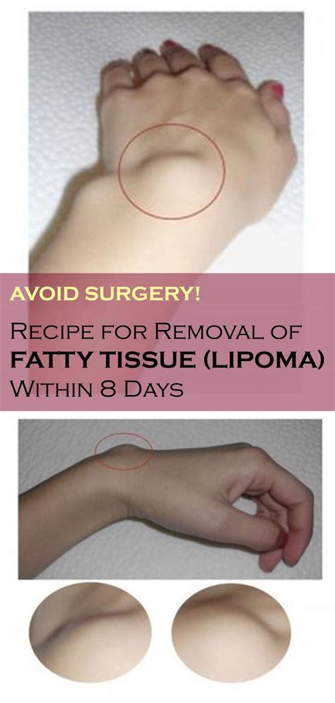 Avoid Your Surgery: Recipe For Removal Of Fatty Tissue (LIPOMA) Within 8 Days | Fatty, Surgery ...