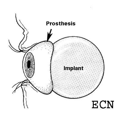 Enucleation: About Ocular Prosthesis Care » New York Eye Cancer Center