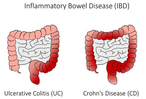 Crohn’s & Colitis - Upopolis