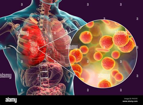 La polmonite causata da Mycoplasma pneumoniae batteri, concettuale ...