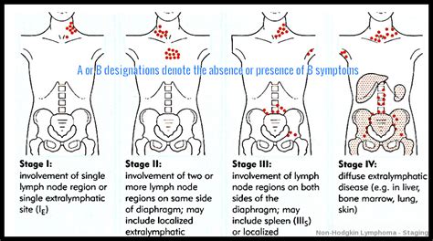 Non-Hodgkin Lymphoma - Ask Hematologist | Understand Hematology