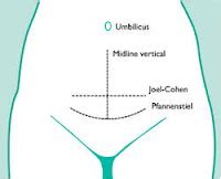 The Well-Rounded Mama: Preventing Cesarean Complications in High BMI Women